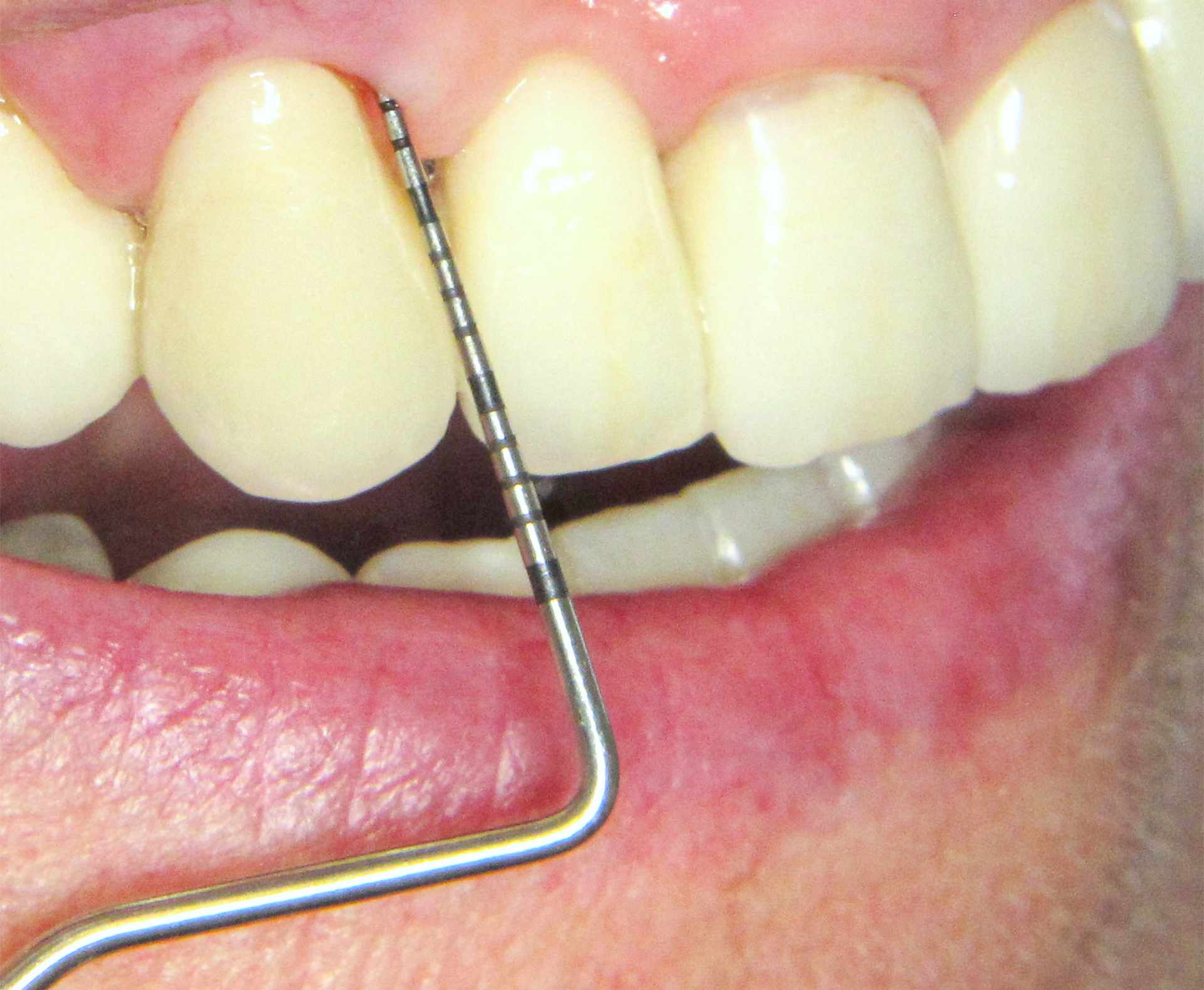 Messung der Zahnfleischtaschentiefe