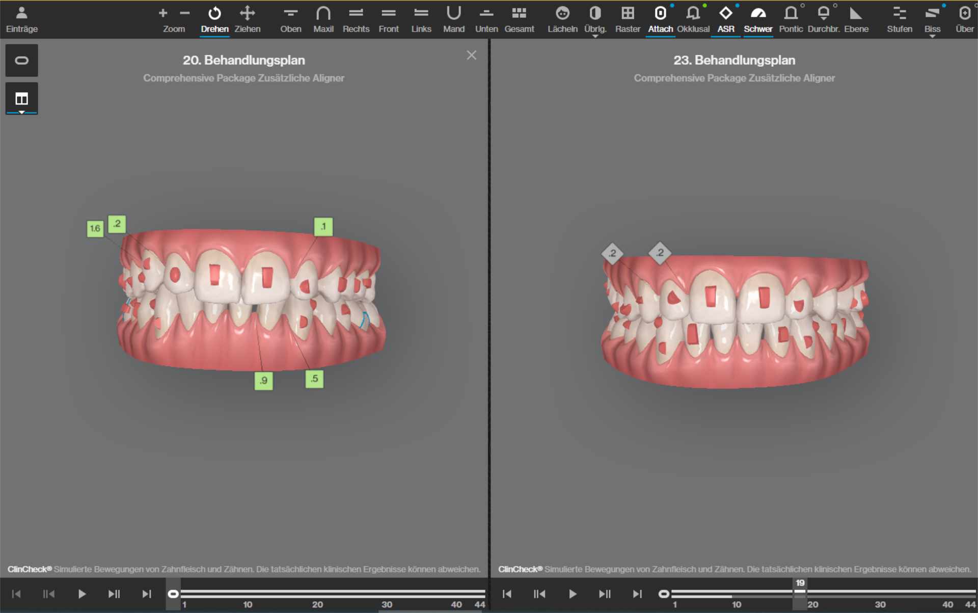3D-Simulation der Zahnbewegungen