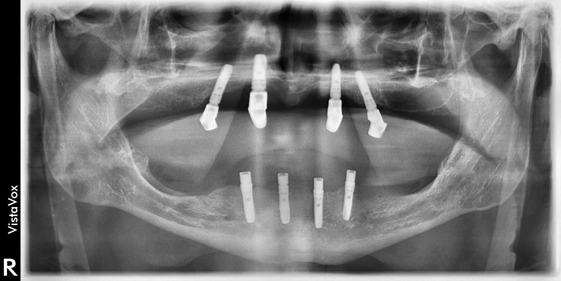 Ober- und Unterkiefer mit je 4 Implantaten zur Verankerung von herausnehmbarem Zahnersatz