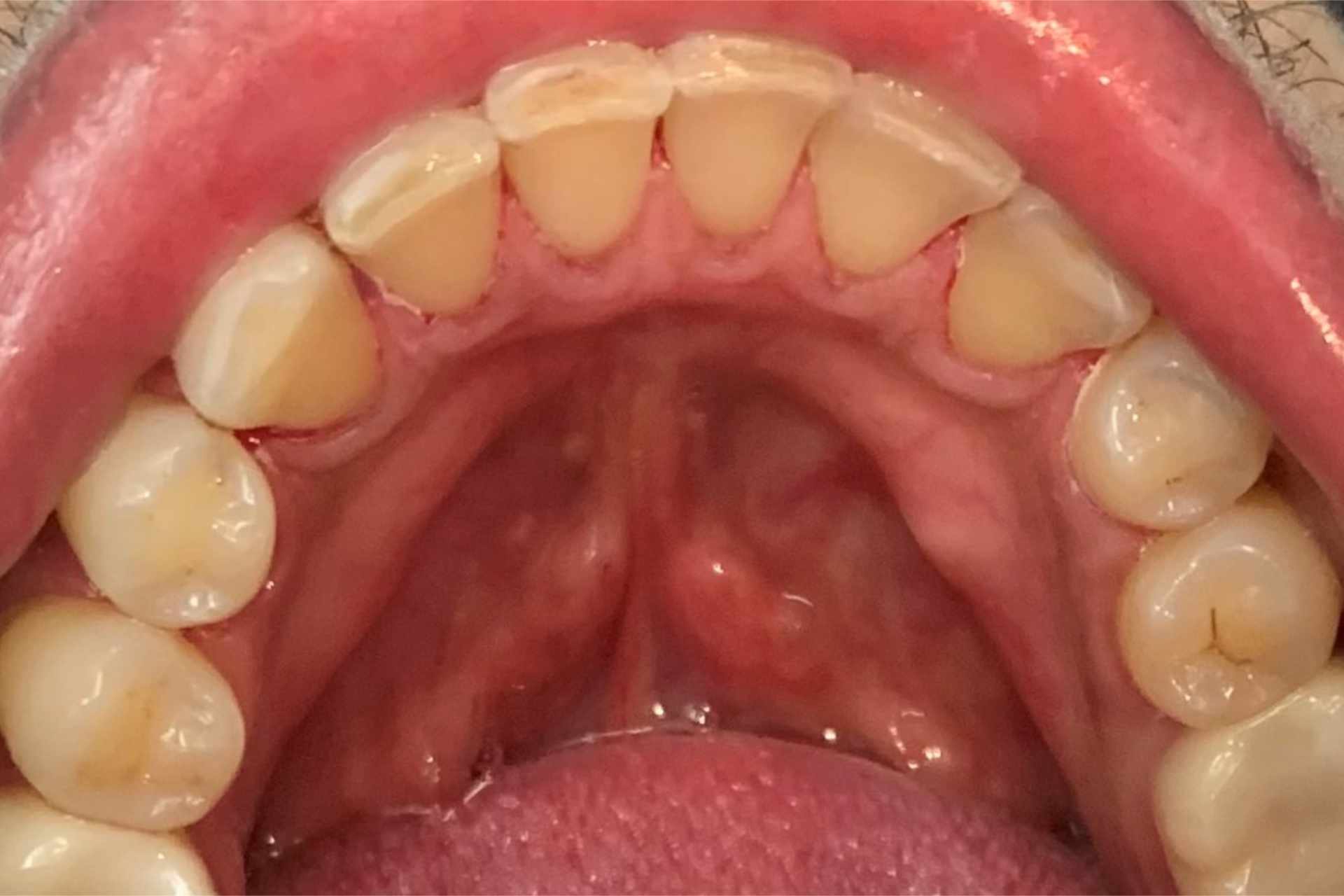 Zähne nach der Zahnreinigung