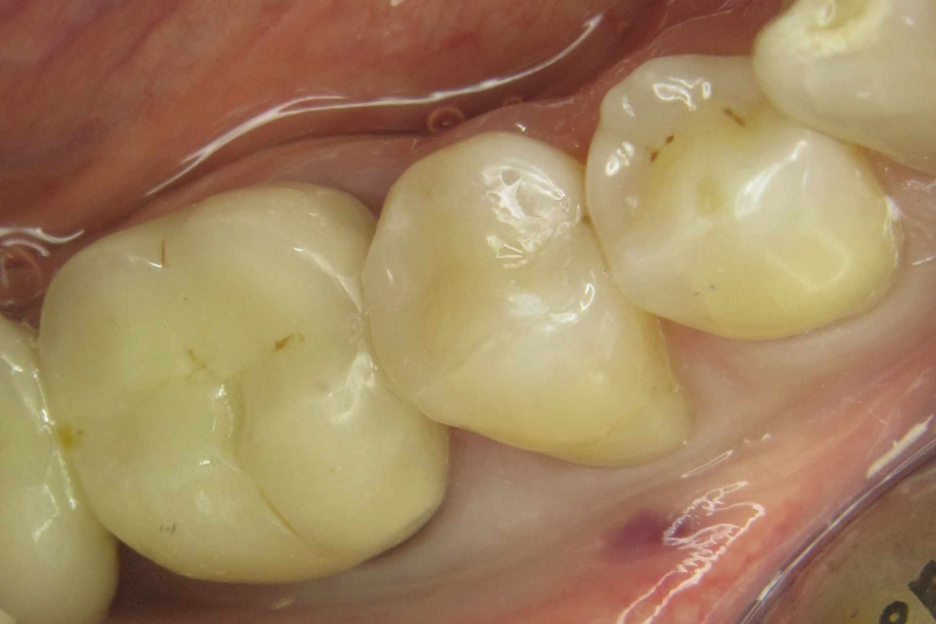 Zahnfarbene Füllung am mittleren Zahn